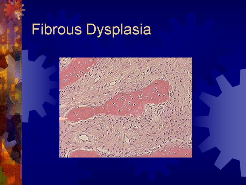 Fibrous Dysplasia